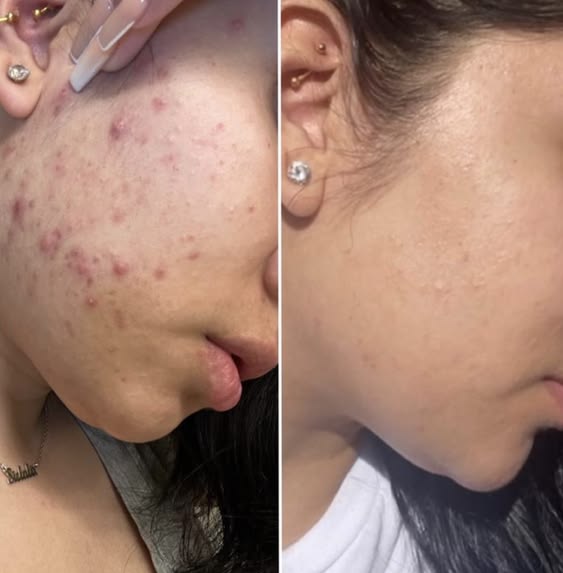 "Gel de Ácido Hipocloroso contra el exceso de sebo y las células muertas."